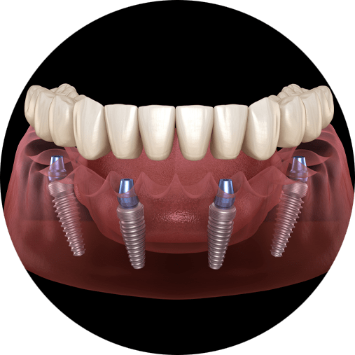 Am I A Candidate For All-On-4® Dental Implants In Stroudsburg, PA?