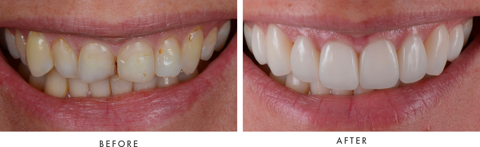 Porcelain Veneers