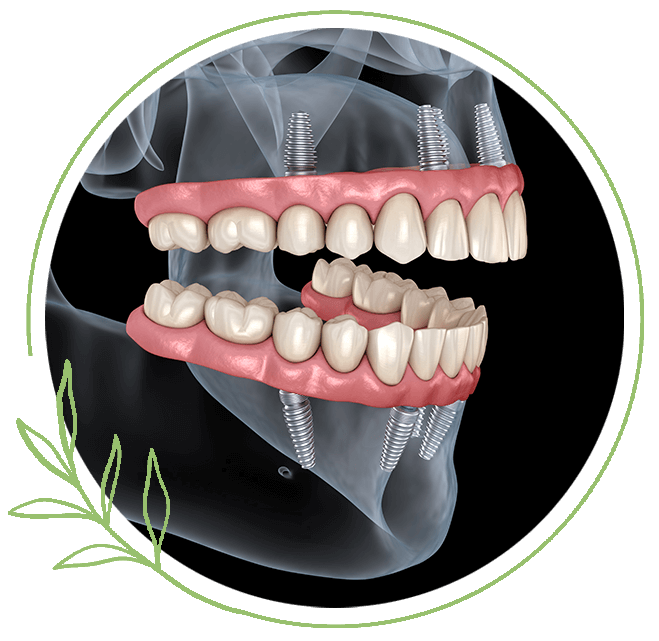 all-on-4 dental implants