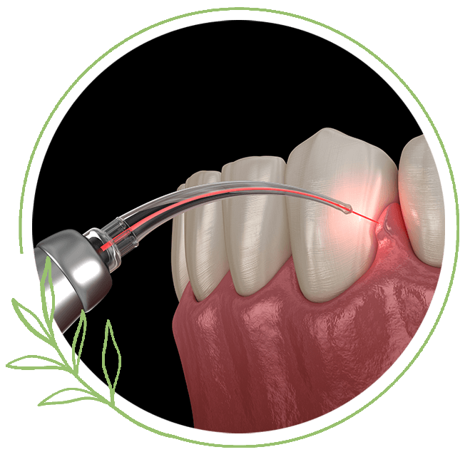 dental laser