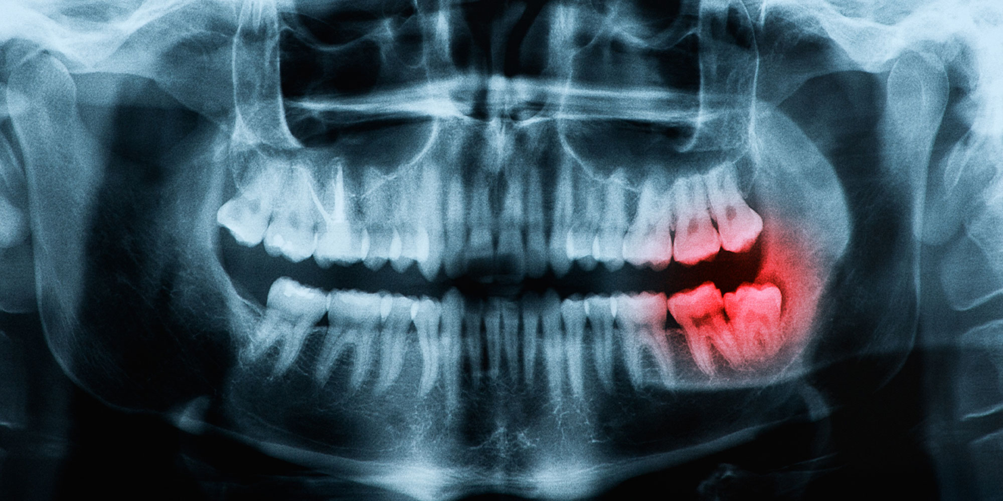 xray of impacted wisdom teeth